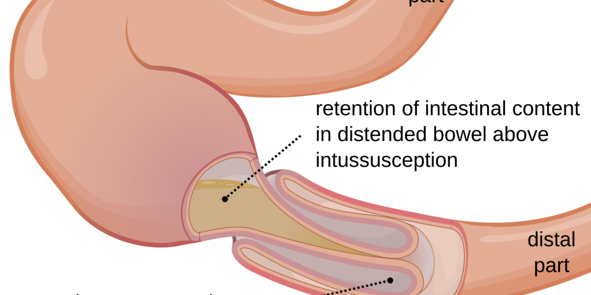Intussusception_EN.svg Intussusception_EN.svg