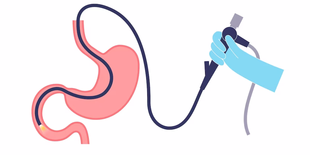 esophagogastroduodenoscopy-medical-poster-diagnostic-endoscopic-minimally-invasive-procedure-visualization-esophagus-stomach-proximal-duodenum-gastroenterology-flat-vector-illustr esophagogastroduodenoscopy-medical-poster-diagnostic-endoscopic-minimally-invasive-procedure-visualization-esophagus-stomach-proximal-duodenum-gastroenterology-flat-vector-illustr